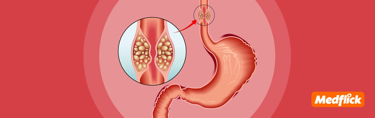 Understanding Esophageal Cancer: Symptoms, Diagnosis, and Treatment