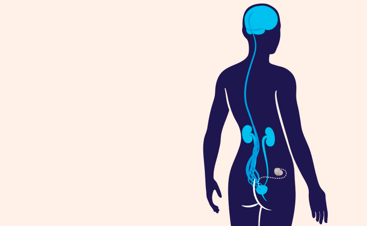 Cost of Interstim Therapy | How to Control Bladder and Bowel in Delhi ...